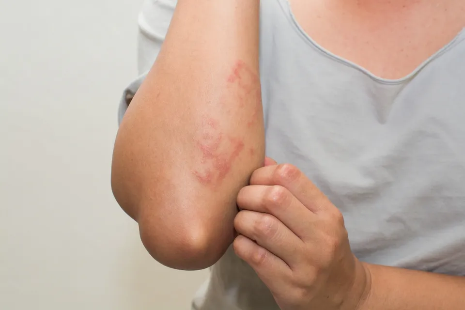Alergia cutánea