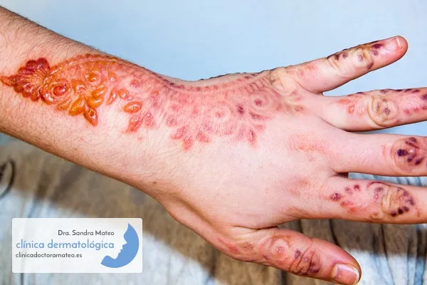 Mano y antebrazo con un dibujo de henna en relieve, la piel enrojecida e hinchada siguiendo el trazo y pequeñas ampollas en los dedos