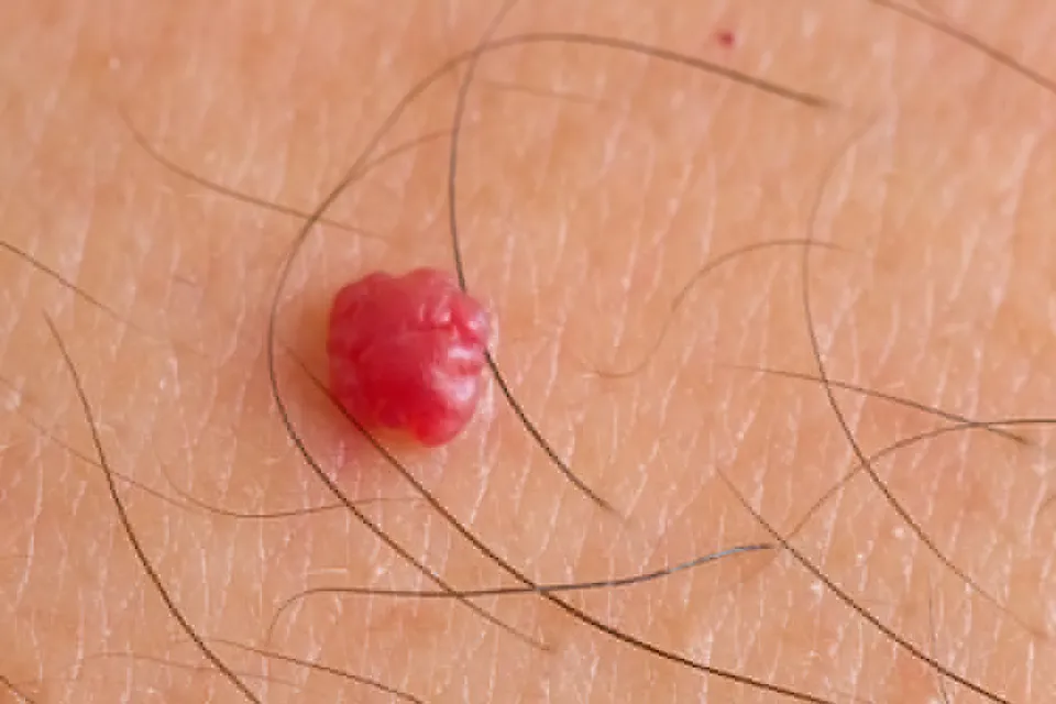 Angiomas y puntos rubí