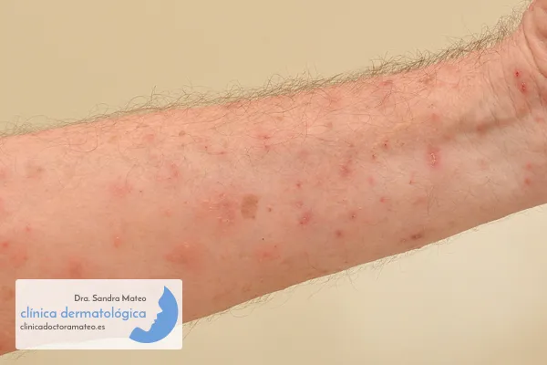 Antebrazo con muchos granitos rojos pequeños y marcas de rascado por sarna