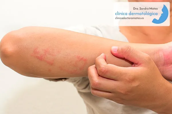 Antebrazo con placas rojas de eccema mientras la otra mano lo rasca