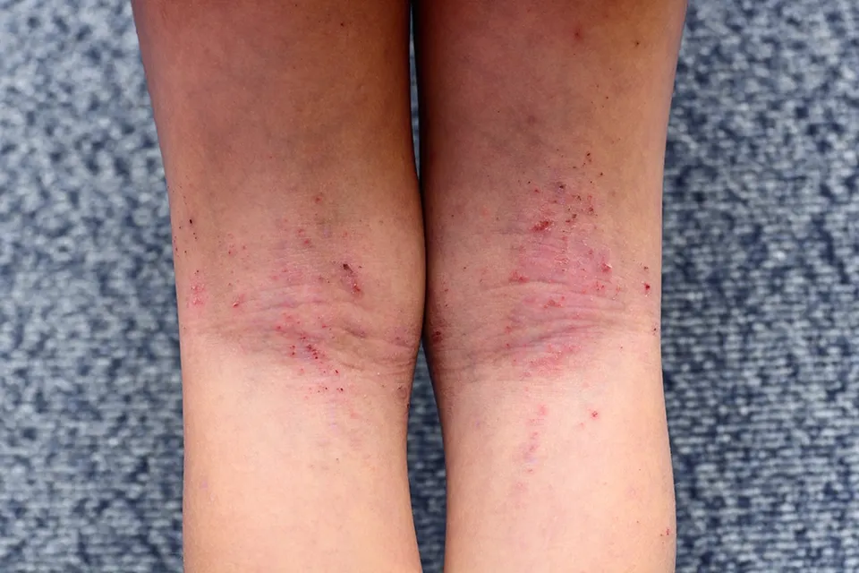 Dermatitis atópica