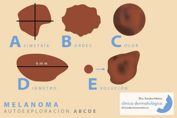 Autoexploración de lunares durante el embarazo. Criterio ABCDE.
