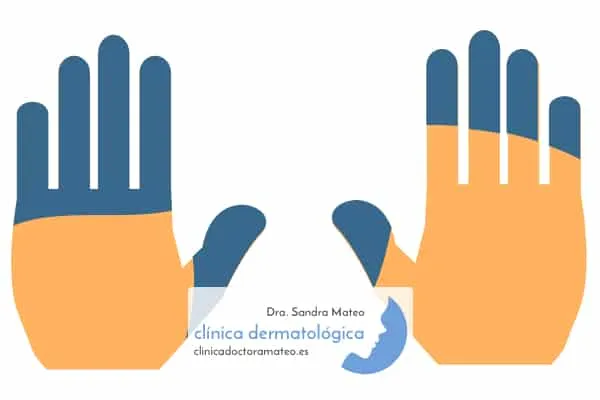 Manos con los dedos y las palmas de color azulado por acrocianosis