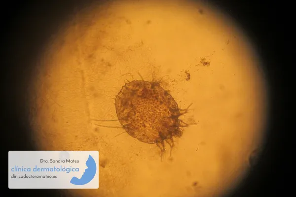 Ácaro de la sarna visto al microscopio