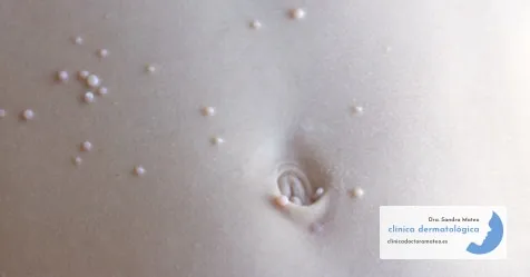 Abdomen de un niño con pequeños granitos redondos y nacarados de molusco contagioso