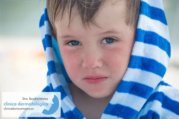 Niño con las mejillas enrojecidas y secas, envuelto en una toalla de rayas azules y blancas