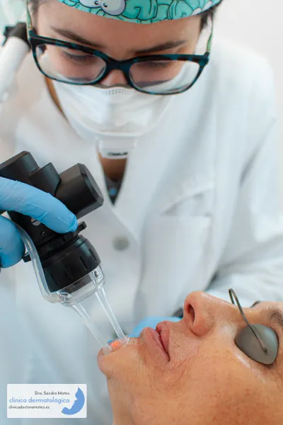 resurfacing-co2-dermatologo-perfil
