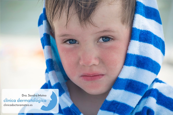 Niño con dermatitis atópica