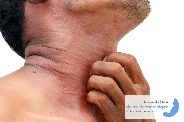 Influencia dermatitis atópica en el adulto en su calidad de vida » Sandra Mateo