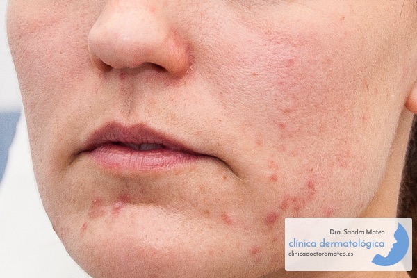 Dermatitis Perioral