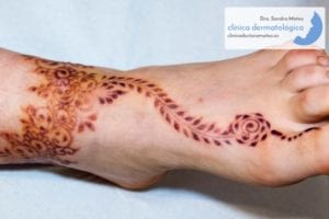 alergia-henna-pie