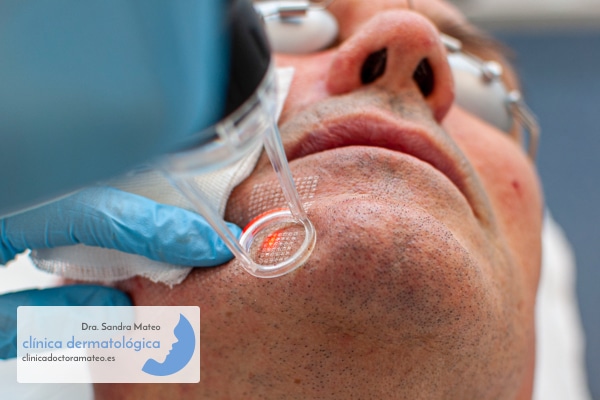 Rejuvenecimiento facial mediante resurfacing con láser CO2 en hombres.