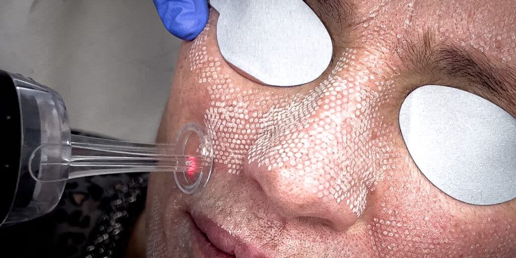 Durante tratamiento láser CO2